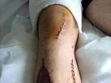 Нога Люка Шоу после двух операций (ФОТО)