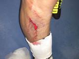 Защитник «Валенсии» выложил в сеть фото своей травмы