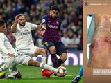 Варан опубликовал фото раздробленного колена после матча с «Барселоной» (ФОТО)