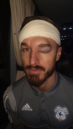 Игрок «Кардиффа» опубликовал фото головы после столкновения с одноклубником (ФОТО)