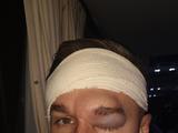 Игрок «Кардиффа» опубликовал фото головы после столкновения с одноклубником (ФОТО)