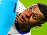 Real Madrid doctors allowed Mbappe not to have nose surgery
