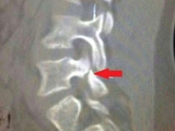 Опубликован рентгеновский снимок перелома Неймара. ЧМ-2014 (ФОТО)