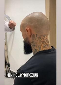 Бывший игрок «Динамо» решил сменить имидж, сделав пересадку волос (ФОТО)