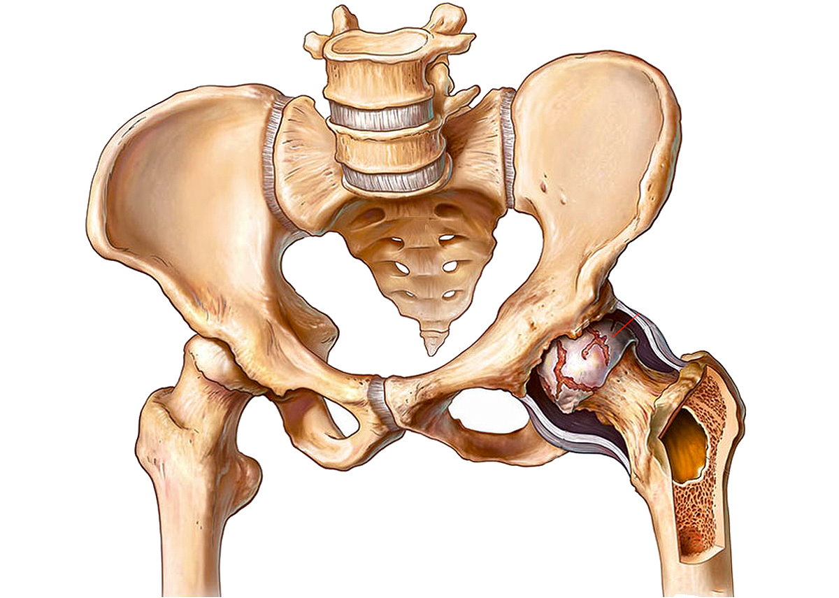 Склероз таза. Коксартроз тазобедренного сустава. Кокриортоз тазабедрынов суставов.