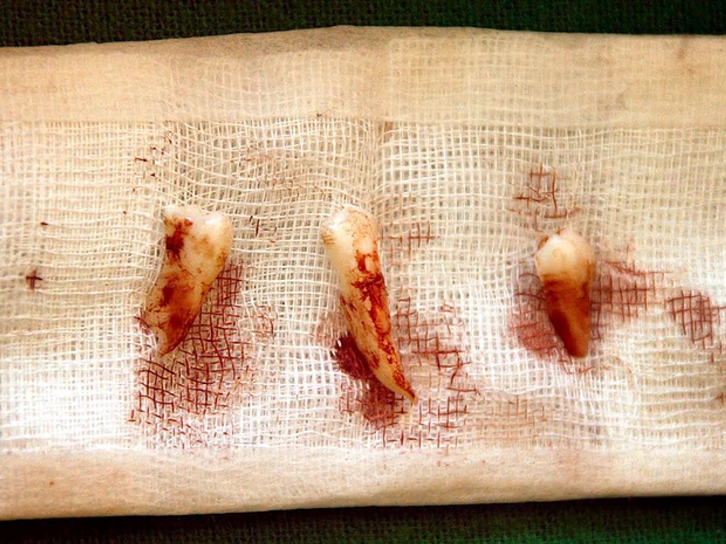 Выбитые зубы Баттистона